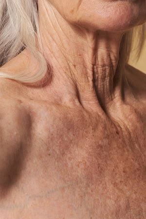Woman considering facial volume loss after GLP-1 weight loss, or "Ozempic face"
